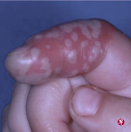 手指型疱疹(图像由医生提供)
