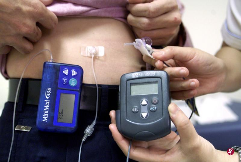 认识糖尿病4:胰岛素泵的使用
