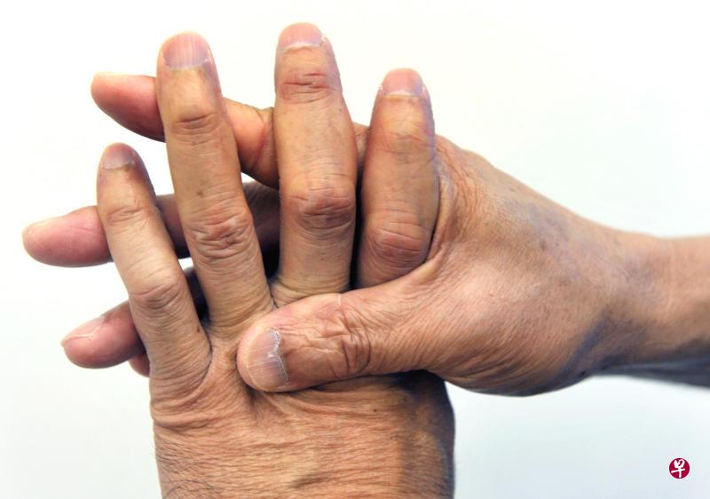 類風溼性關節炎(rheumatoid arthritis),也就是俗稱